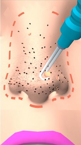 挤黑头大师 0.2 安卓版